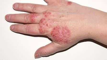 Common Skin Conditions: Causes, Symptoms, and Effective Treatments