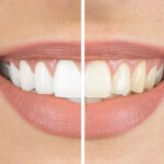 4 Questions To Ask Before Whitening Your Teeth