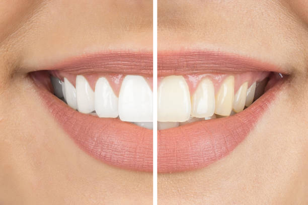 4 Questions To Ask Before Whitening Your Teeth