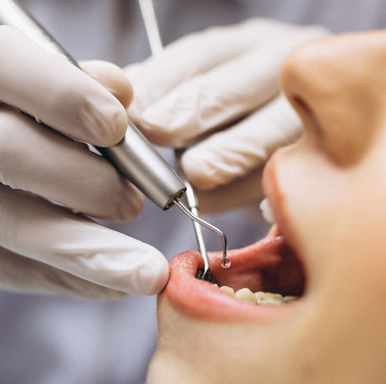 Common Myths About Dental Implants
