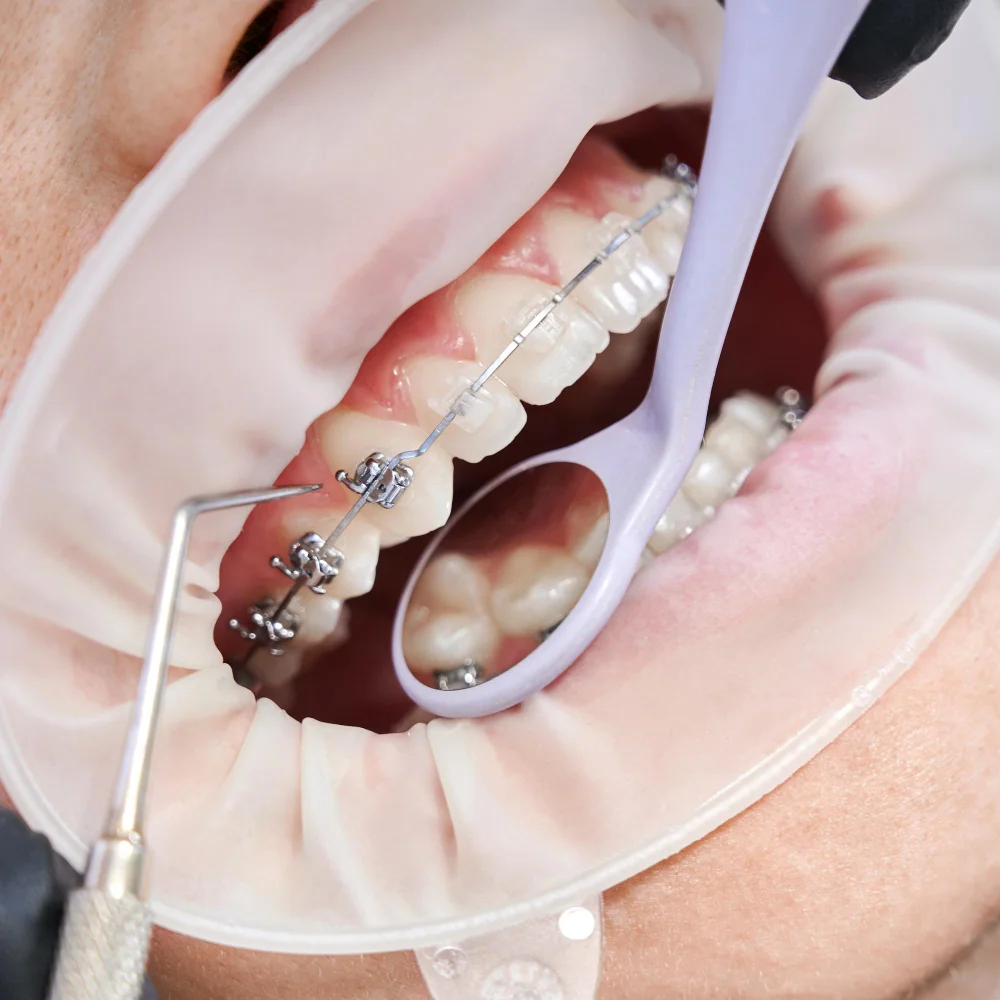 How To Maintain Tooth Health After Getting a Crown