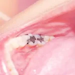 Signs You Need a Dental Filling