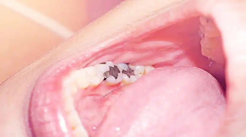 Signs You Need a Dental Filling