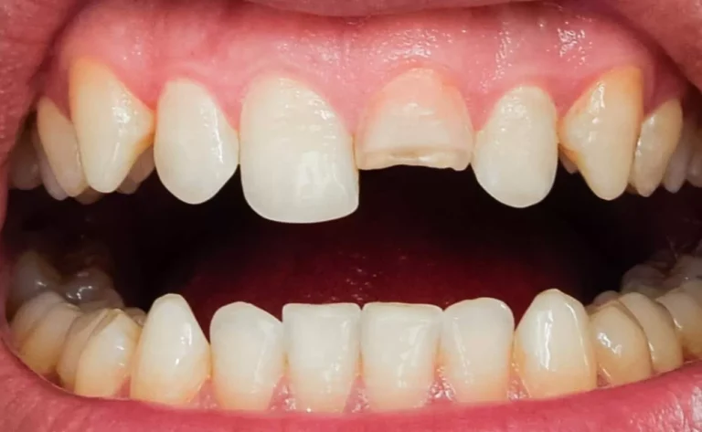 What to Do If You Break or Knock Out a Tooth