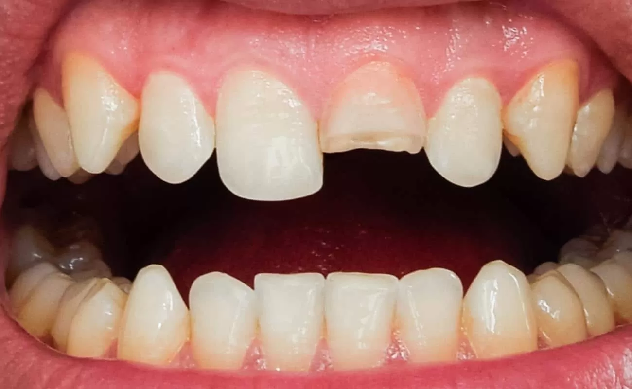 What to Do If You Break or Knock Out a Tooth