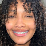 The Role of Braces in Orthodontics for Teens and Adults