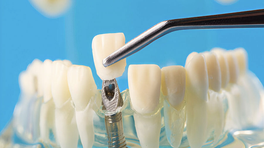 How to Choose the Right Precision Dental Burs for Optimal Performance